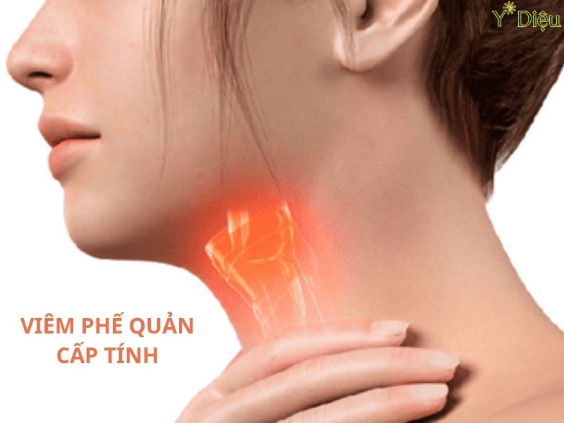 Viêm Phế Quản Cấp Tính: Chuẩn Đoán Phòng Ngừa Và Điều Trị